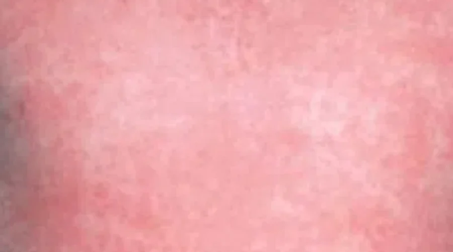 Case of Scarlet Fever In Moncton School