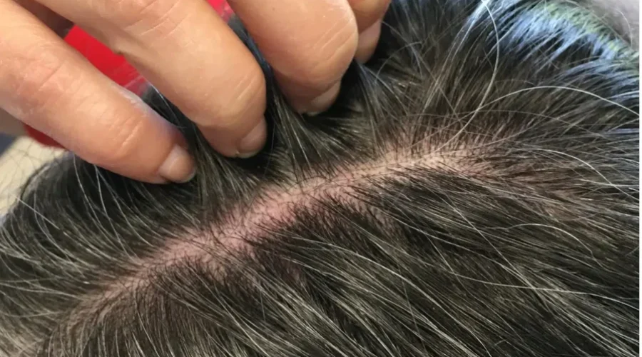 NB Doctor Says Head Lice Can Affect Anyone