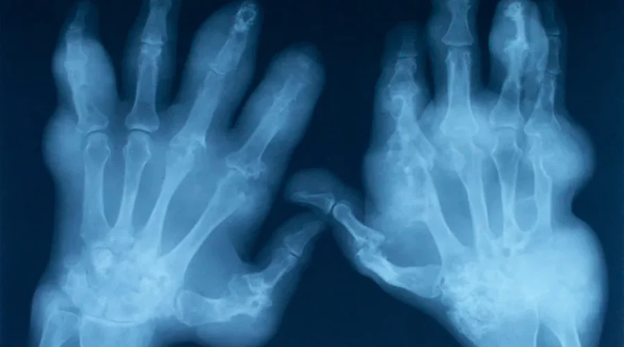 Provincial Government Makes Investment To Reduce Orthopedic Surgery Wait Times