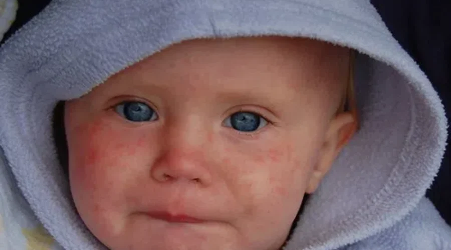 Potential Measles Exposure In Moncton