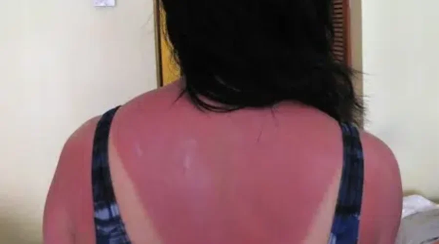 Importance Of Protecting Your Skin From The Sun