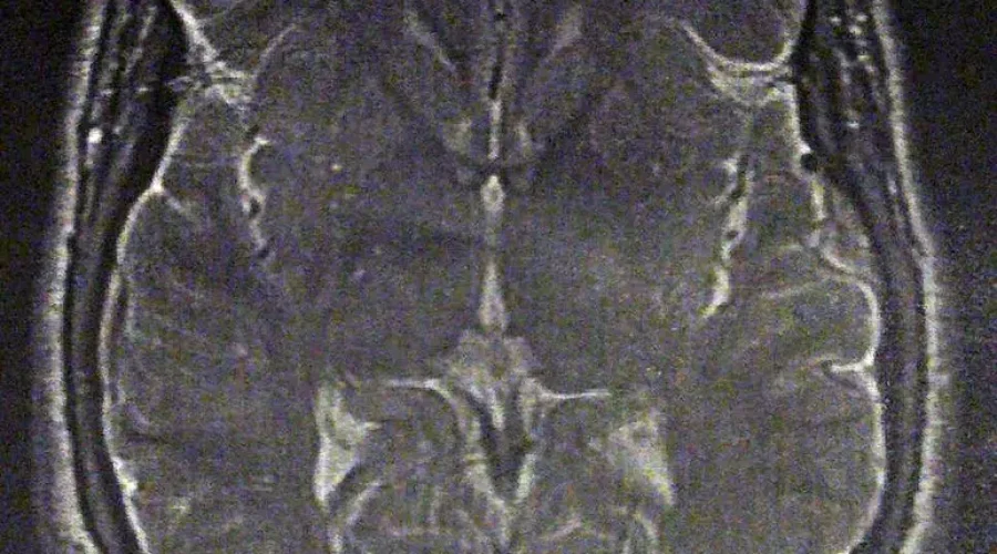 Advocacy Group Seeks Transparency In Mysterious Neurological Syndrome Investigation